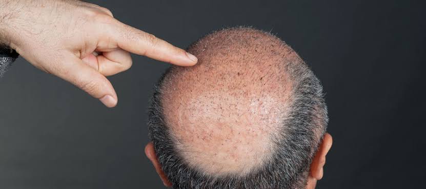 Entenda o que é e como funciona o transplante capilar FUE (Extração da Unidade Folicular)